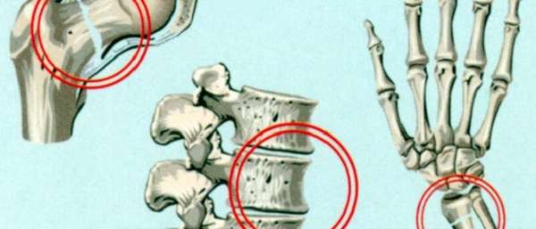 Переломы костей при остеопорозе